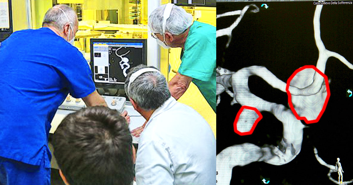 Successo a Casa Sollievo, operato in un’unica seduta un raro caso di doppio aneurisma cerebrale Casa Sollievo della Sofferenza